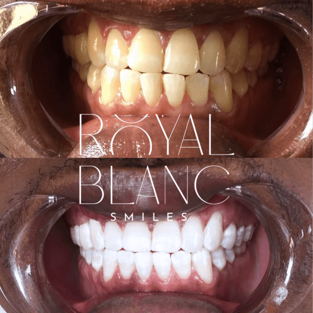 Maximum Teeth Whitening Package at Royal Blanc Smiles - Teeth Whitening and Tooth Gems in Charlotte, NC in Charlotte, NC