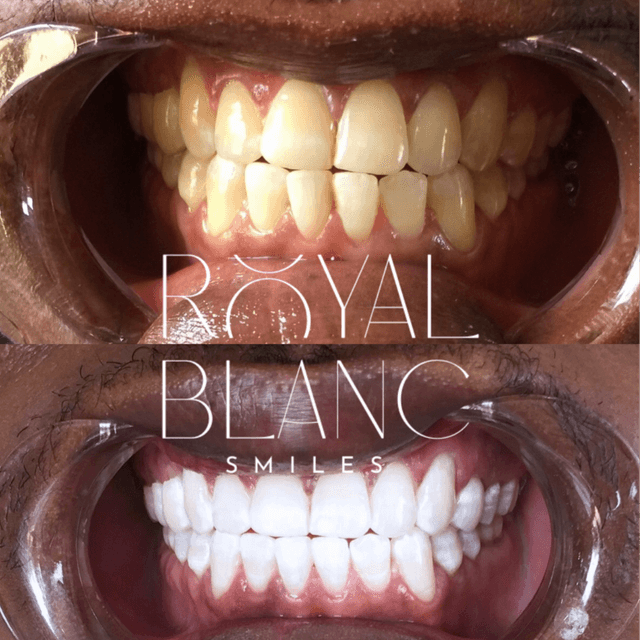 Unlimited Whitening– $499/year at Royal Blanc Smiles - Teeth Whitening and Tooth Gems in Charlotte, NC in Charlotte, NC